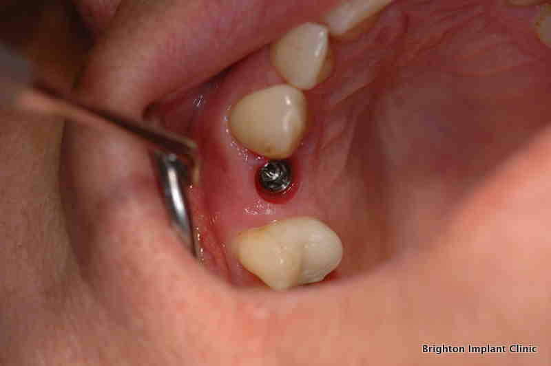 How long do crowns last on implants?