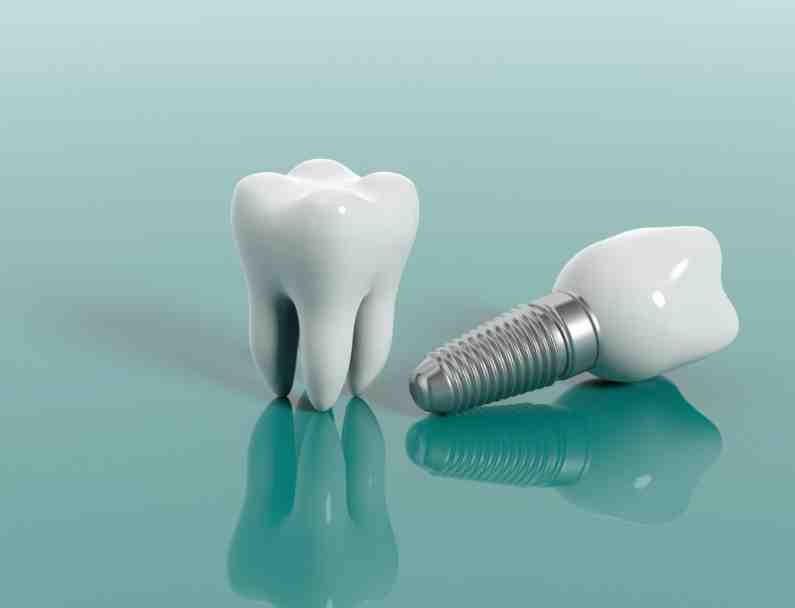 How to help dental implant recovery reddit Dental News Network