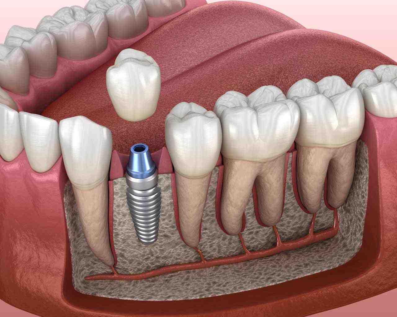 How long to wait after bone graft for dental implant Dental News Network