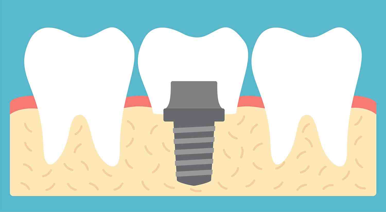 How long does a dental implant procedure take?