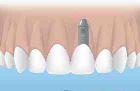 How long does a tooth implant take from start to finish?