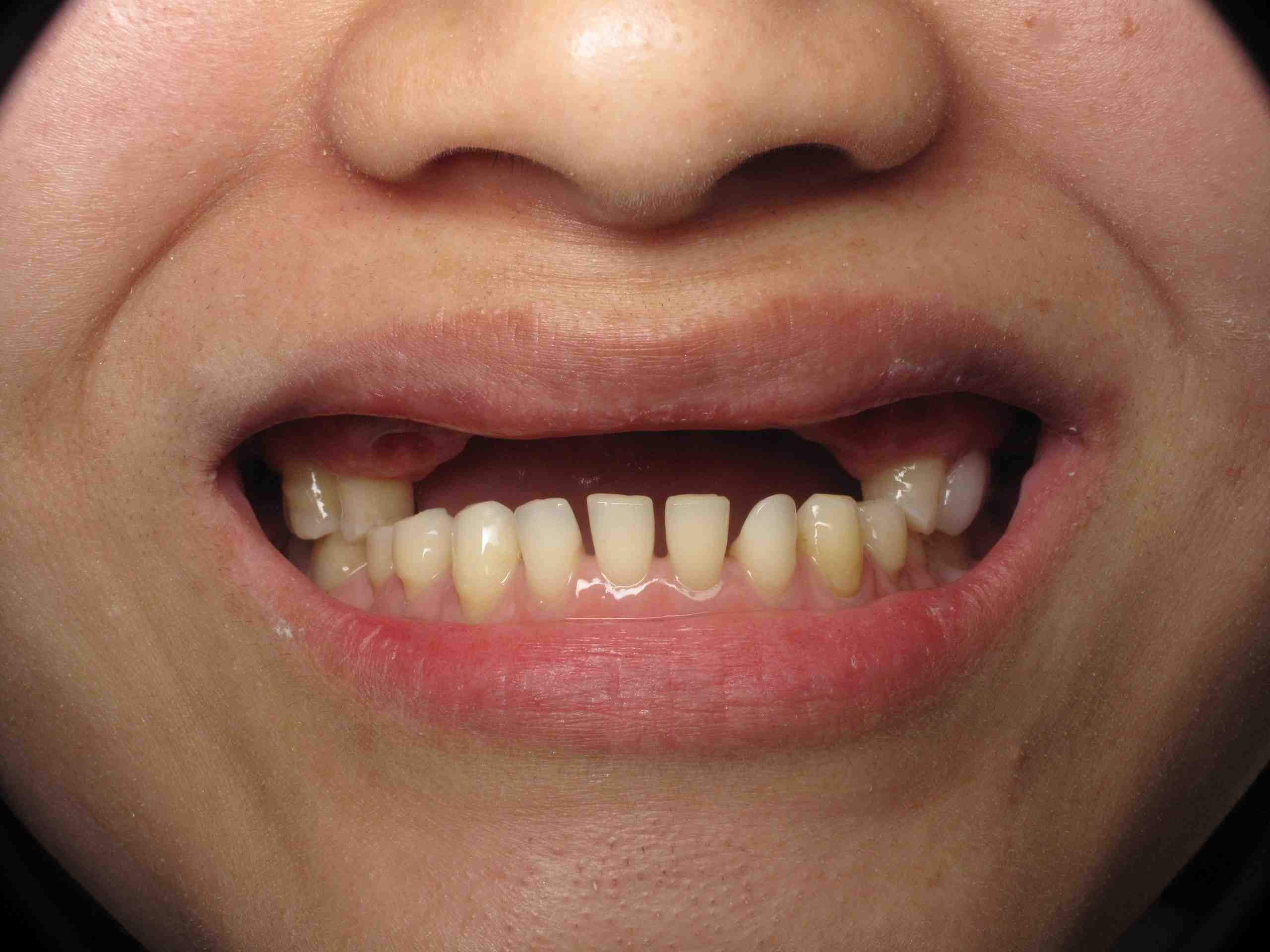 What is dental implant with bone graft Dental News Network