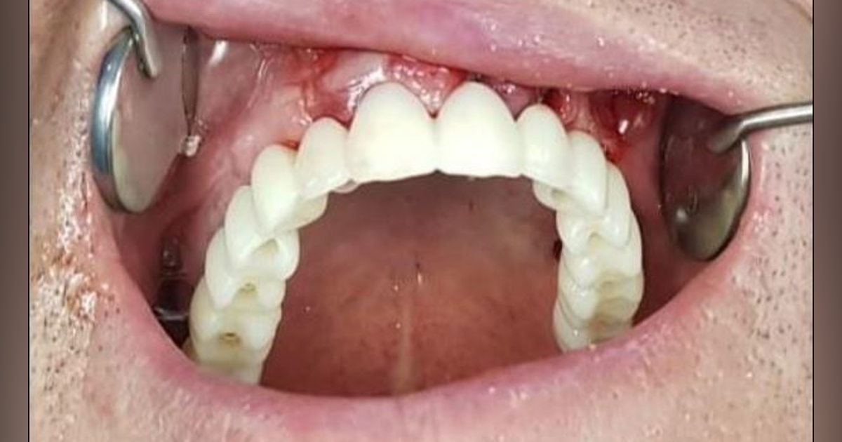 How long does it take for a front tooth implant to heal?