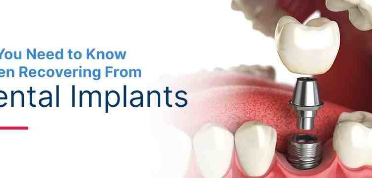 How Long Does It Take To Remove A Dental Implant