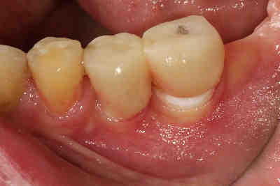 How long does the pain last after a dental implant?
