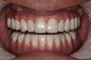 How long eat soft food after dental implant?