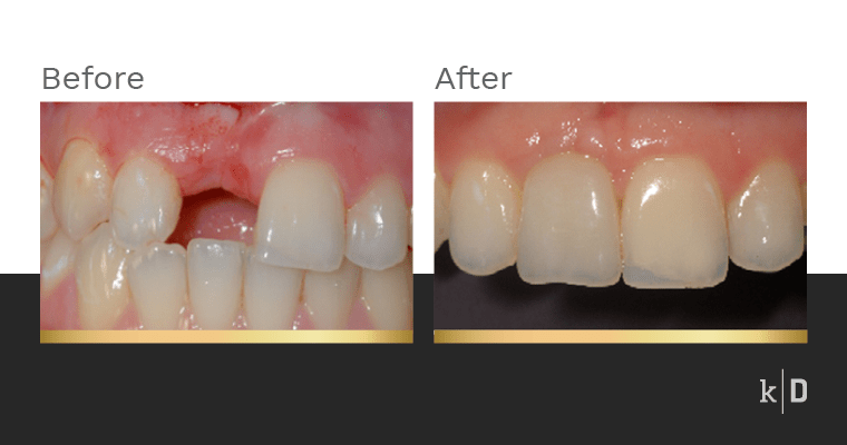 How long is a dental implant procedure?