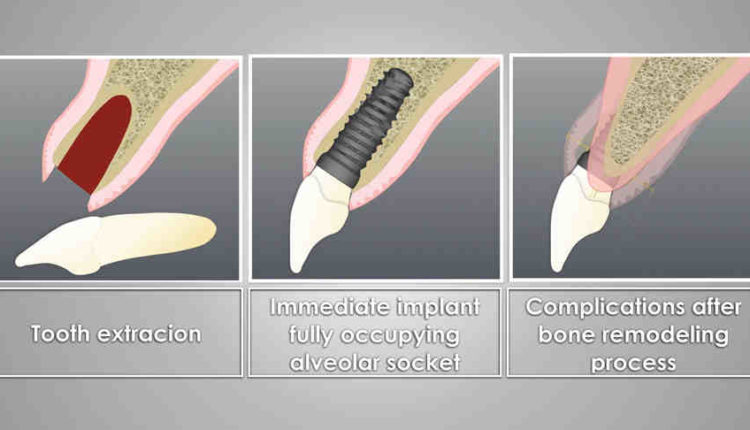How long to wait after bone graft for dental implant