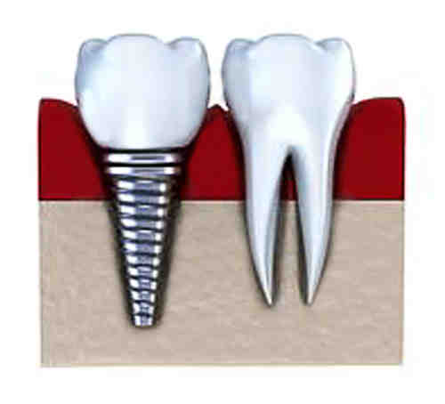 How many days rest after dental implant?