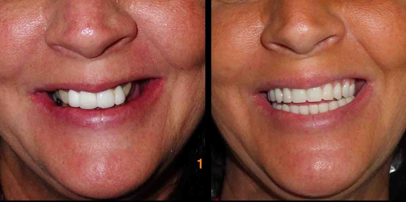 How Much Does Full Set Of Dental Implants Cost Dental News Network