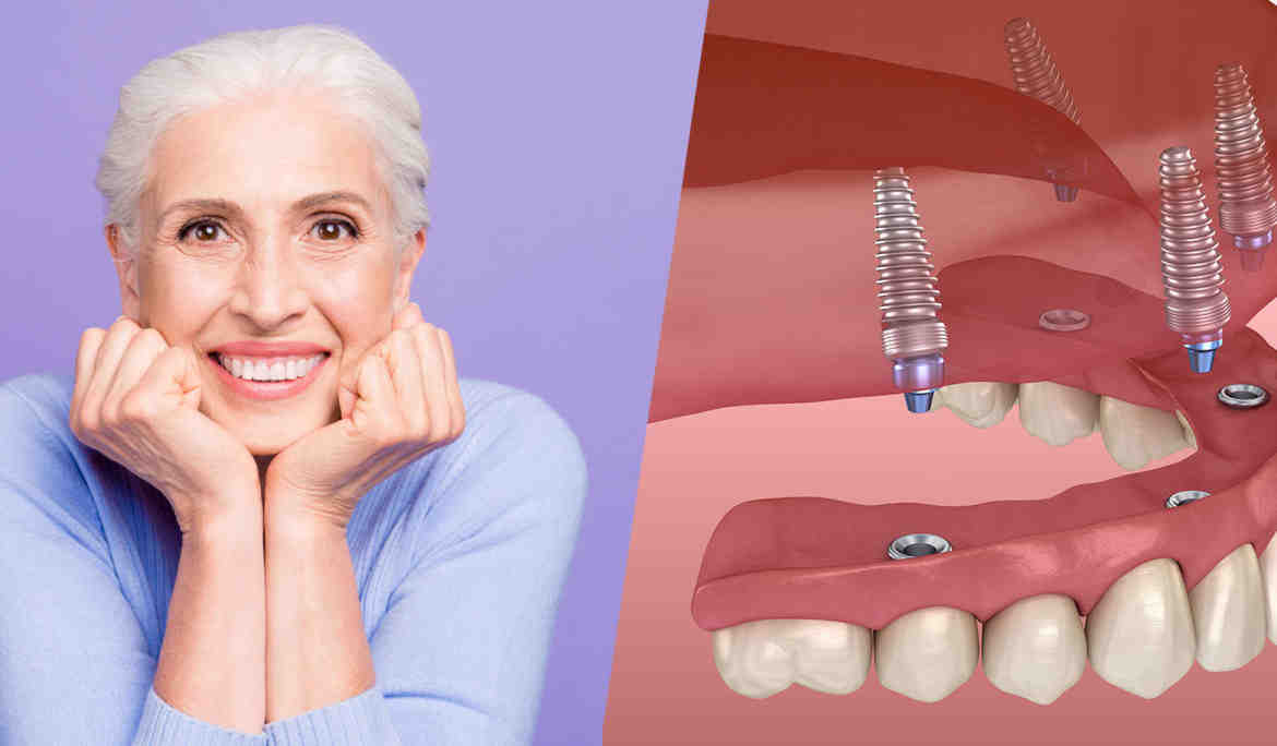 How many implants are needed for full mouth?