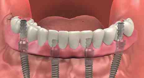 How Much Is Two Dental Implants