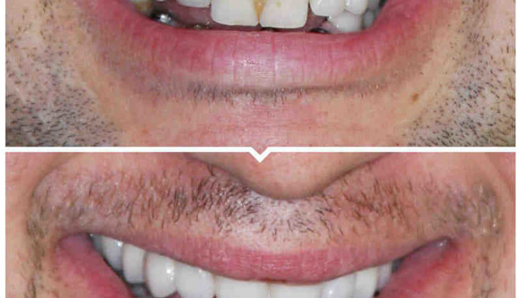 How much are dental implants for whole mouth