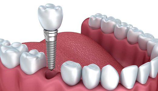 How much do all on 4 dental implants cost UK?