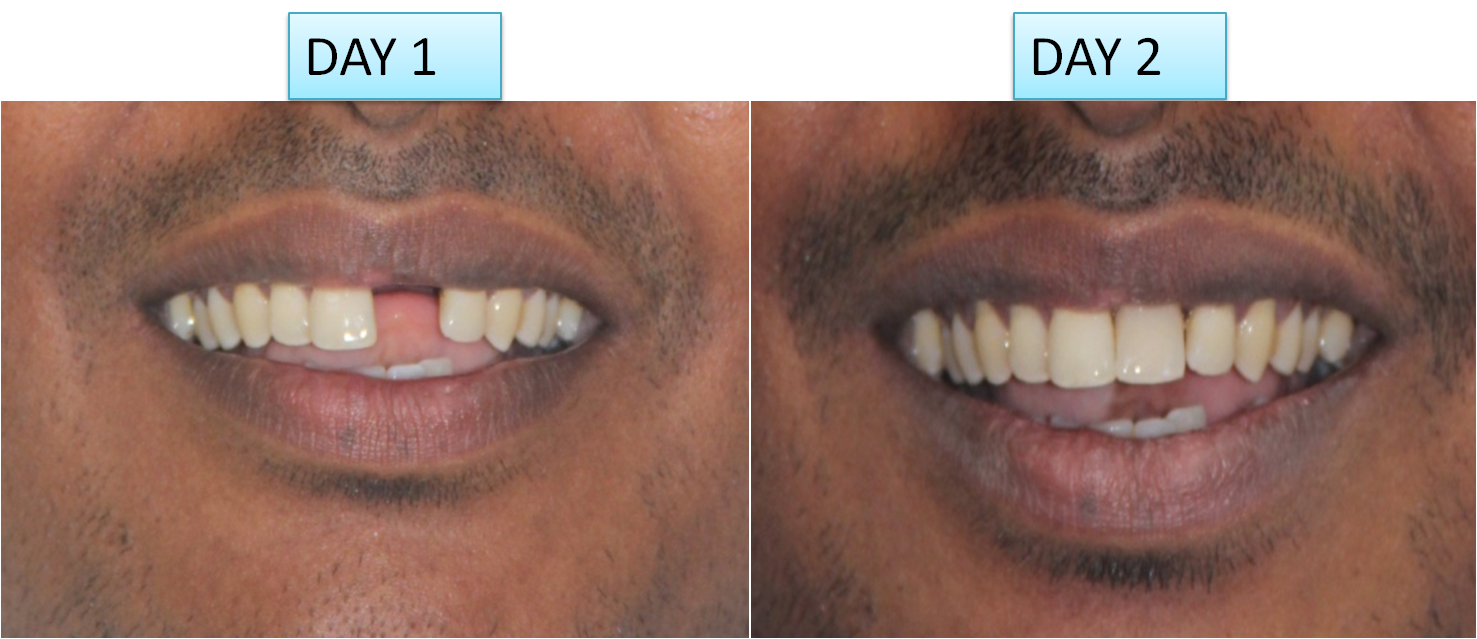 How much one dental implant cost Dental News Network