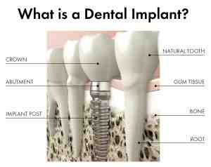 How much do implant supported dentures cost?