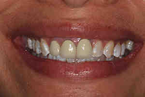 How much do veneers cost in Colorado?