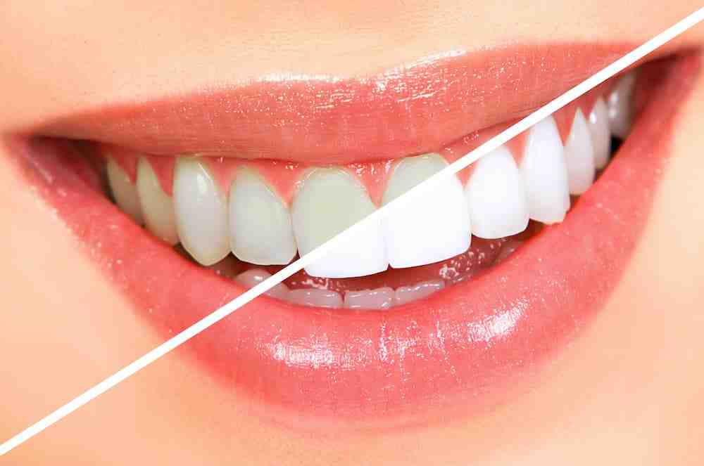 How much do veneers cost in WV?