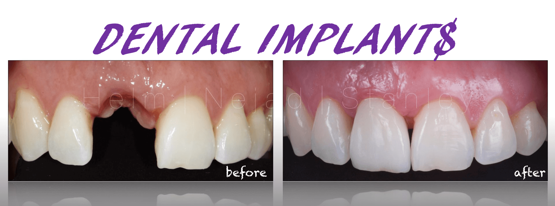 How much does a dental implant cost for one tooth?