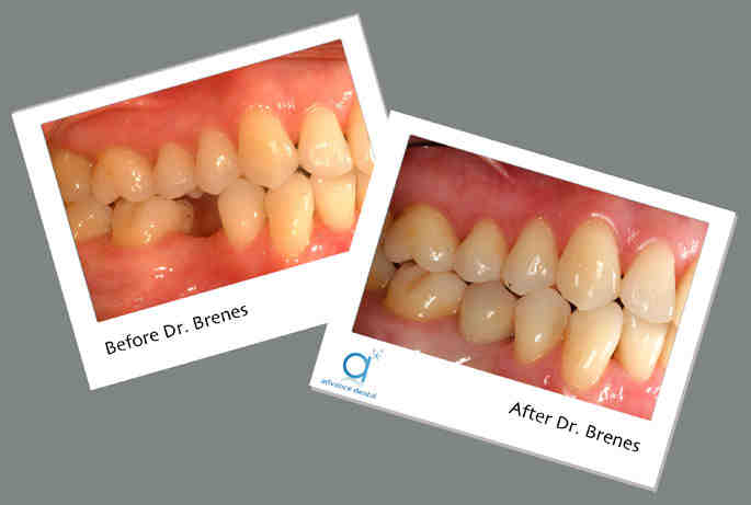 How much does a dental implant cost for one tooth?