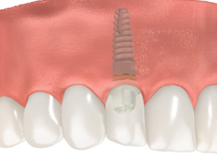 How much does a dental implant cost for one tooth?