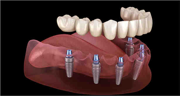 How much does a dental implant cost out of pocket?
