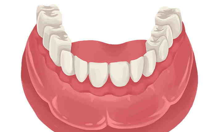 How much does aspen dental charge for implant dentures in ohio