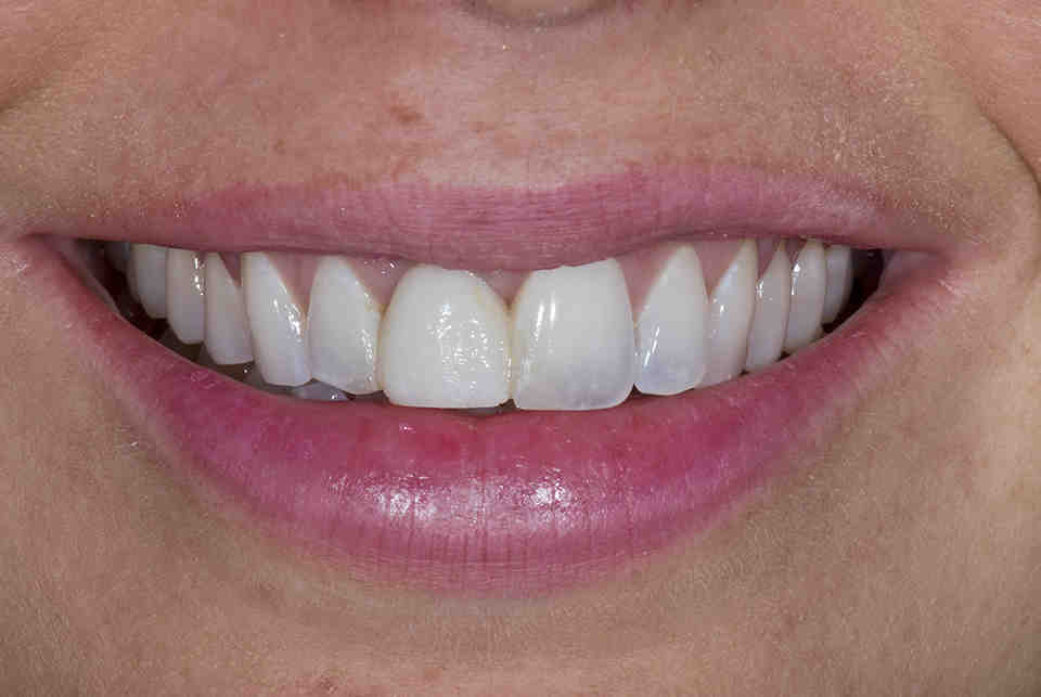 Cosmetic dentistry portland bone graft implants Dental News Network