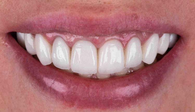 How much does dental implants usually cost