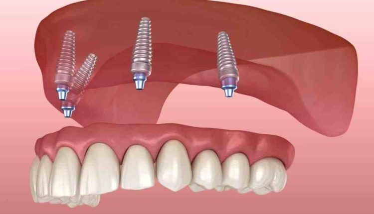 How much does insurance pay for dental implants