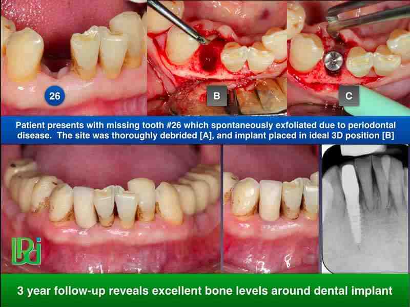 How much does it cost to get a full mouth of dental implants in New York?