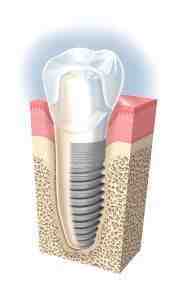 How much does it cost to get your teeth professionally whitened?