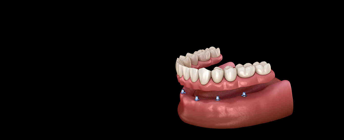 How much does it cost to replace all your teeth?