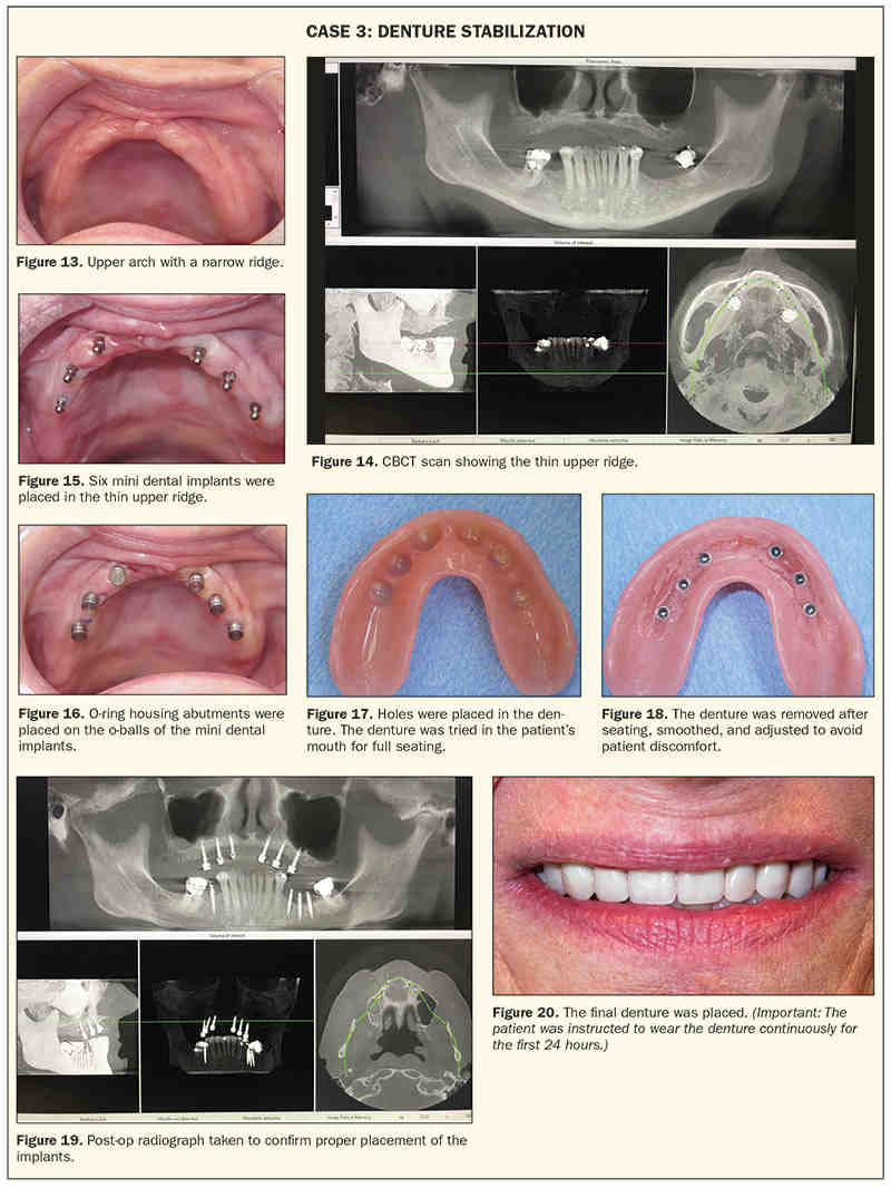 How much does it cost to turn dentures into implants?