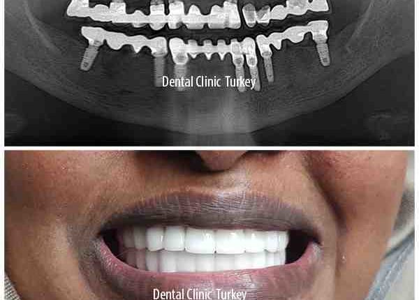 How much i have to pay for dental implants for full mouth per month