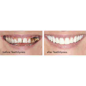 How much is a full set of dental implants UK?