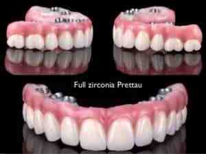 How much is a full set of dental implants UK?