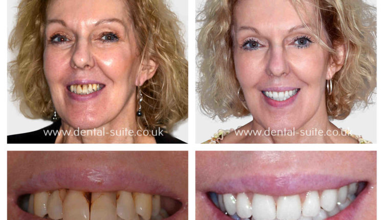 How much is a full set of dental implants cost