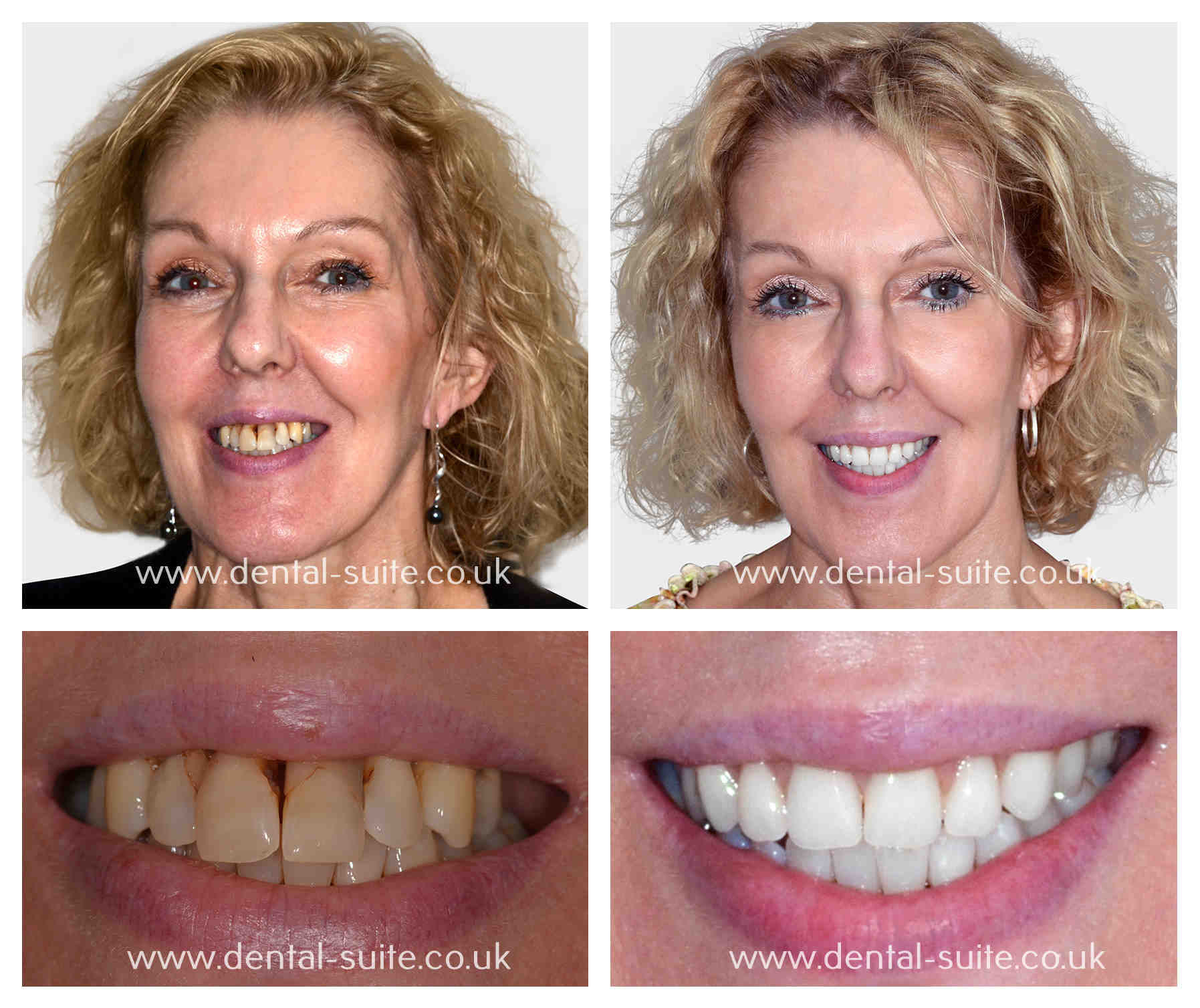 how-much-is-a-full-set-of-dental-implants-cost-dental-news-network