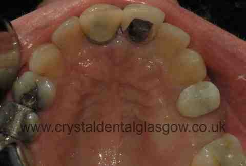 How much will dental implants cost in 2020?