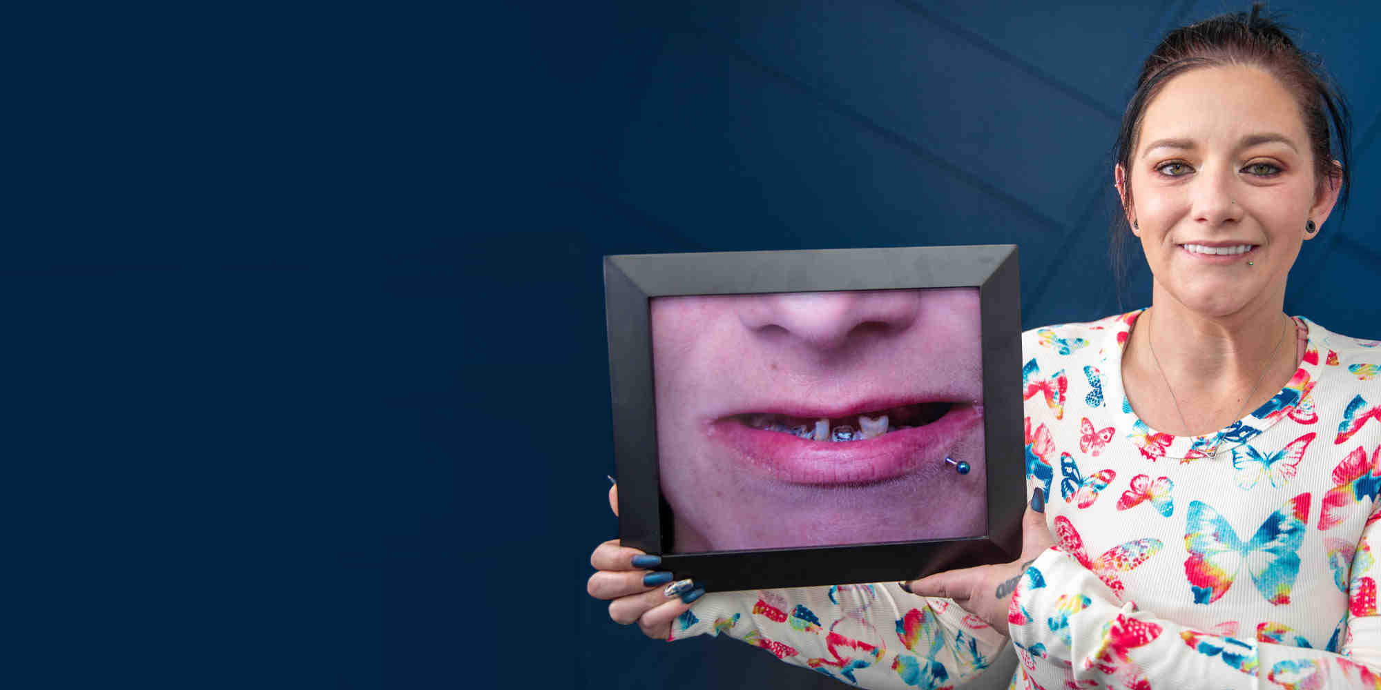 How much would a full mouth of dental implants cost?