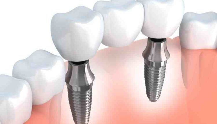 How much would dental implants cost