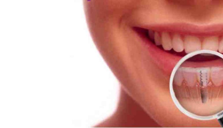 How strong are dental implants
