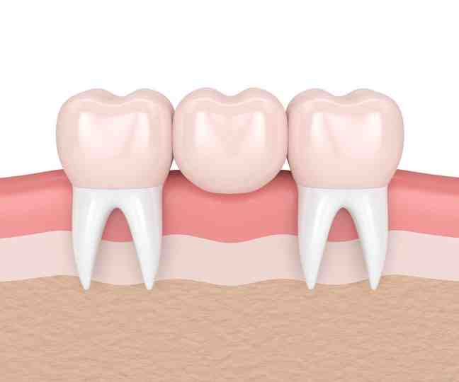 Which is better dental implants or bridges Dental News Network