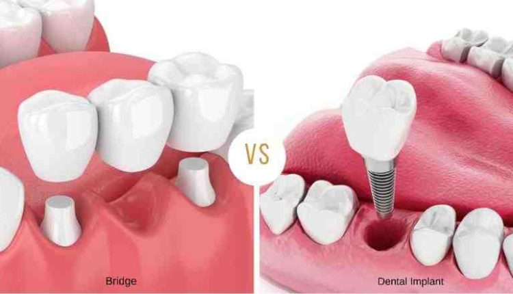Is a dental implant better than a bridge