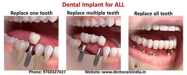 Is a dental implant painful?