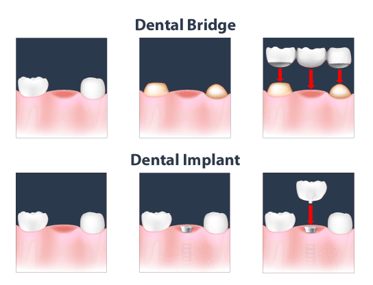 Is a dental implant better than a bridge - Dental News Network