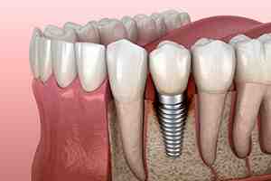 Is dental implant failure common?