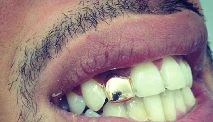 Is dental implant haram