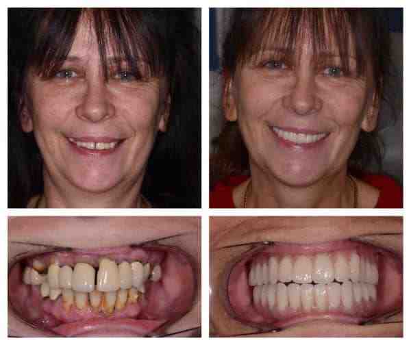 Is it difficult to remove a dental implant?